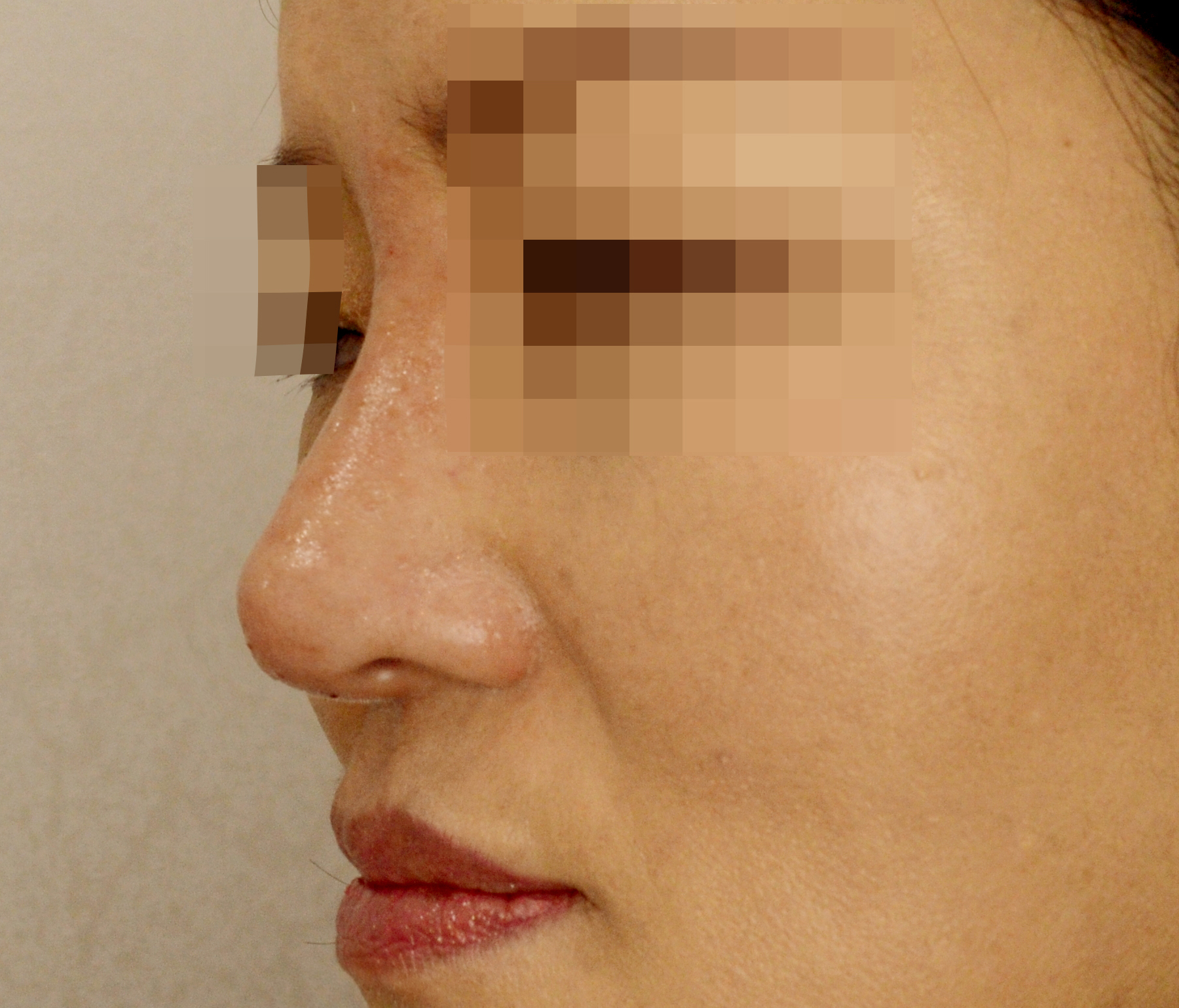 서 희순_20140103_보톡스시술후_384.jpg