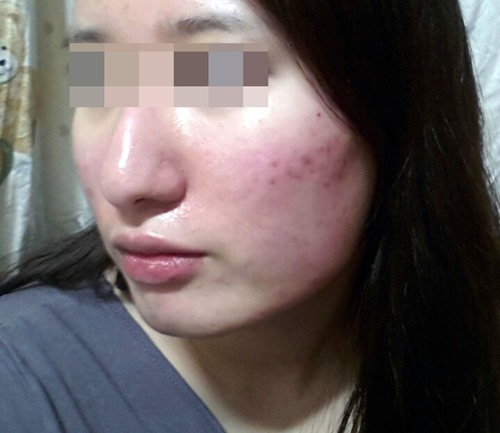 포샵+여드름관리 비포보정.jpg