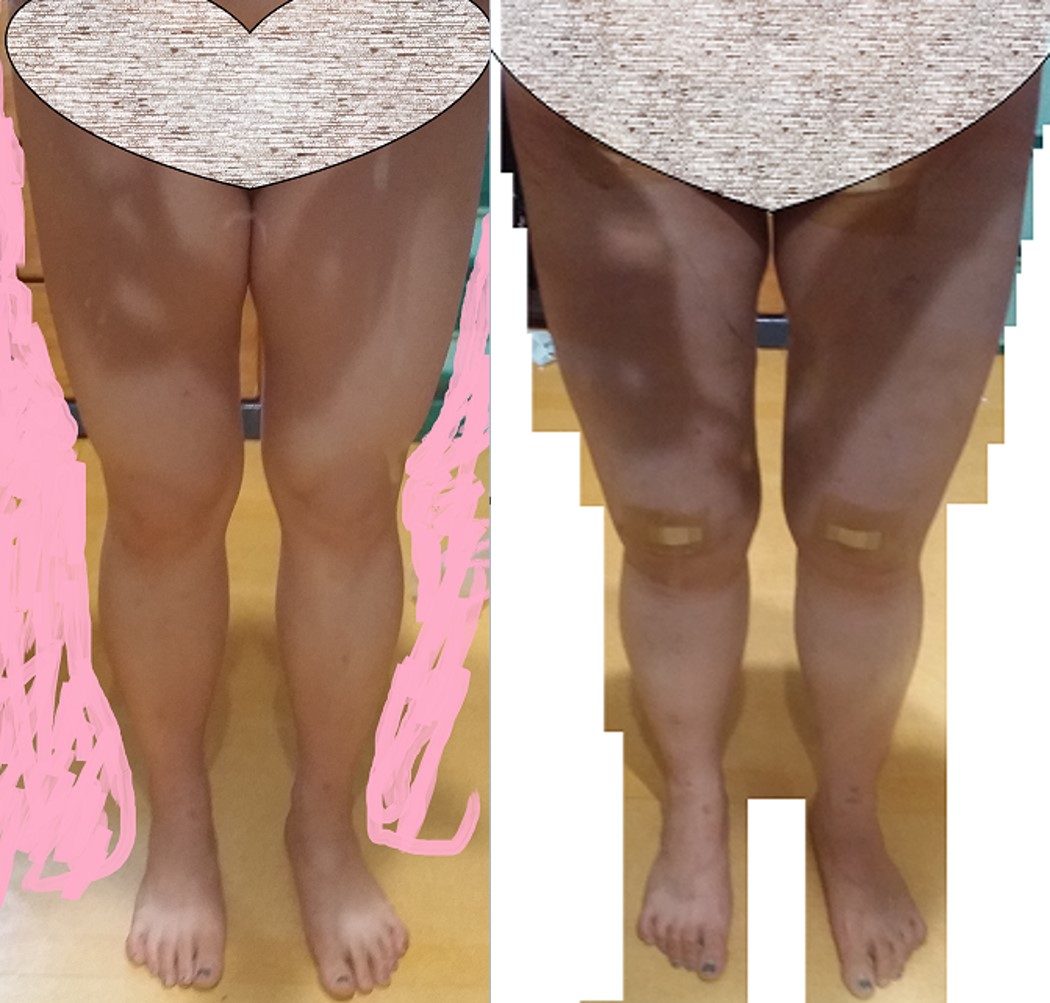 전후비교(D+3).jpg